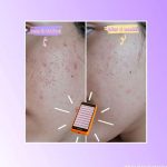 DemarkQ POP Red Light Therapy Device Anti Acne Skincare