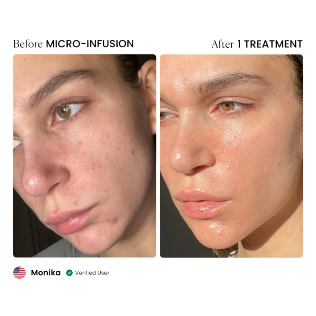 Qure - Microinfusion