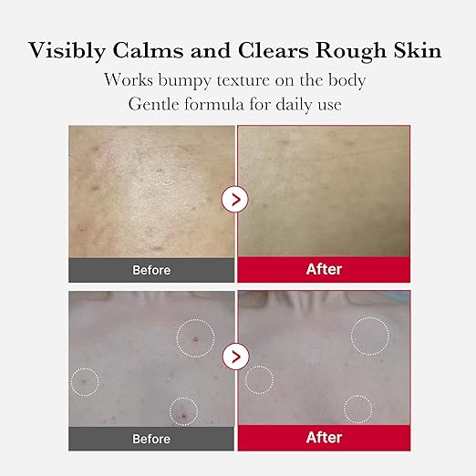 MEDICUBE-RED ACNE BODY PEELING SHOT 2.0 110g