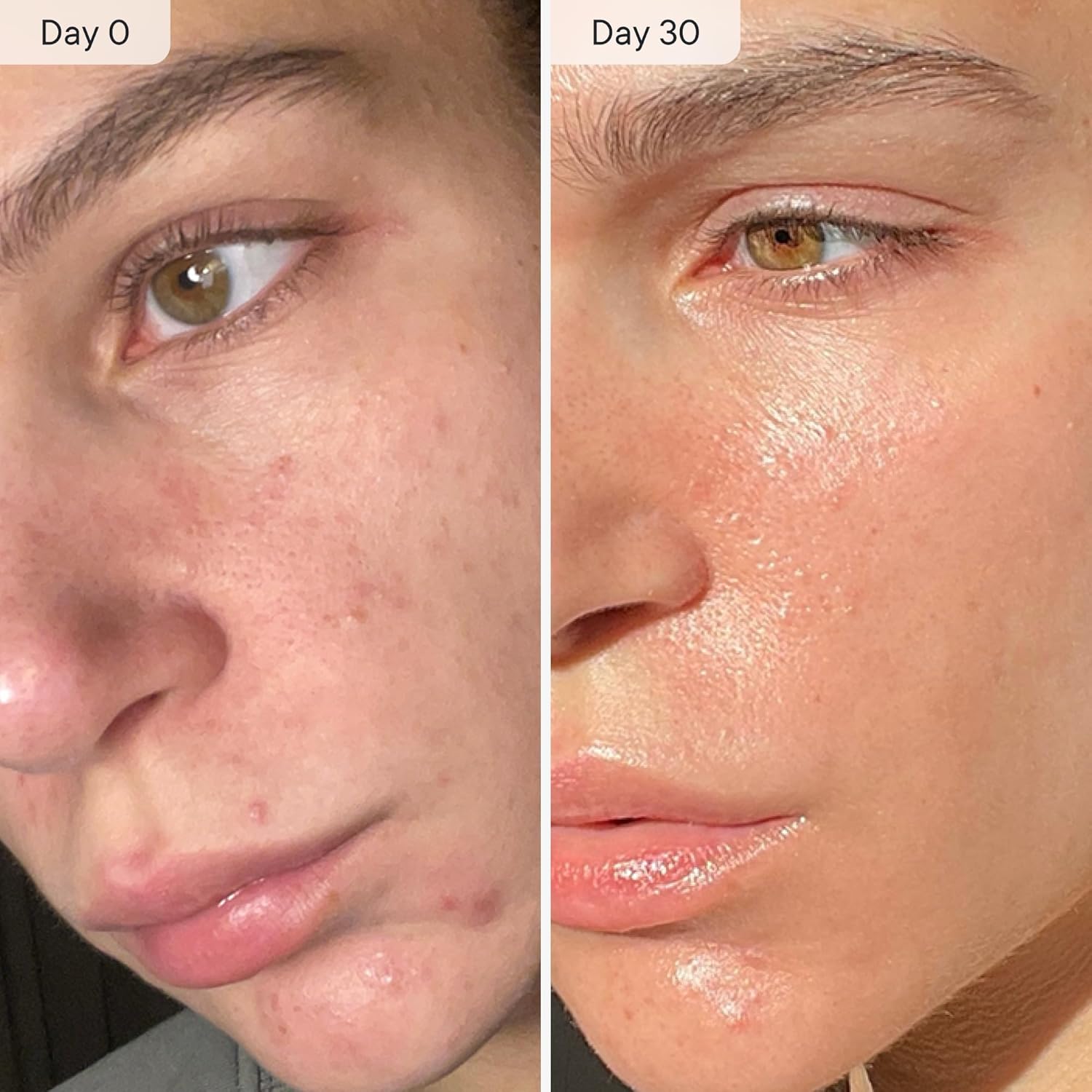 Qure - Microinfusion