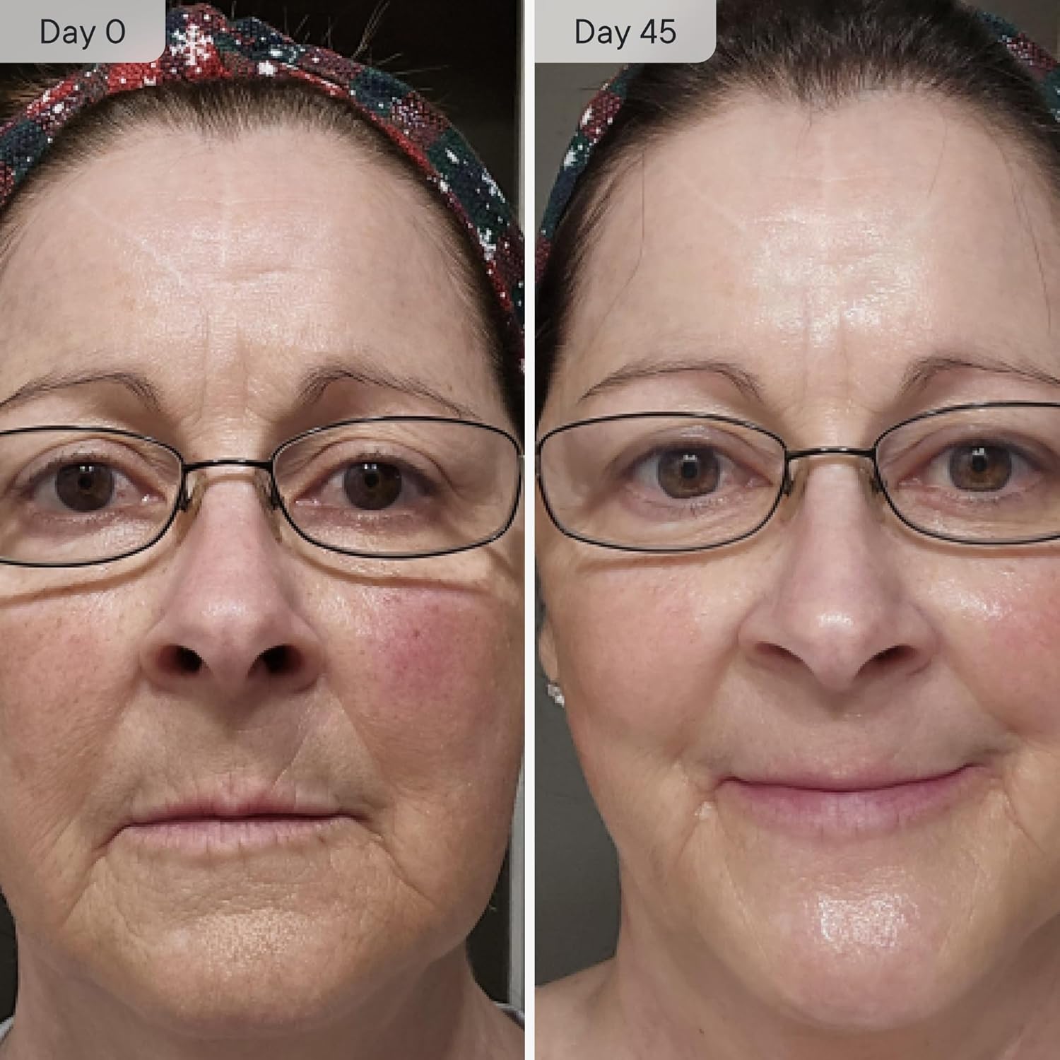 Qure - Microinfusion