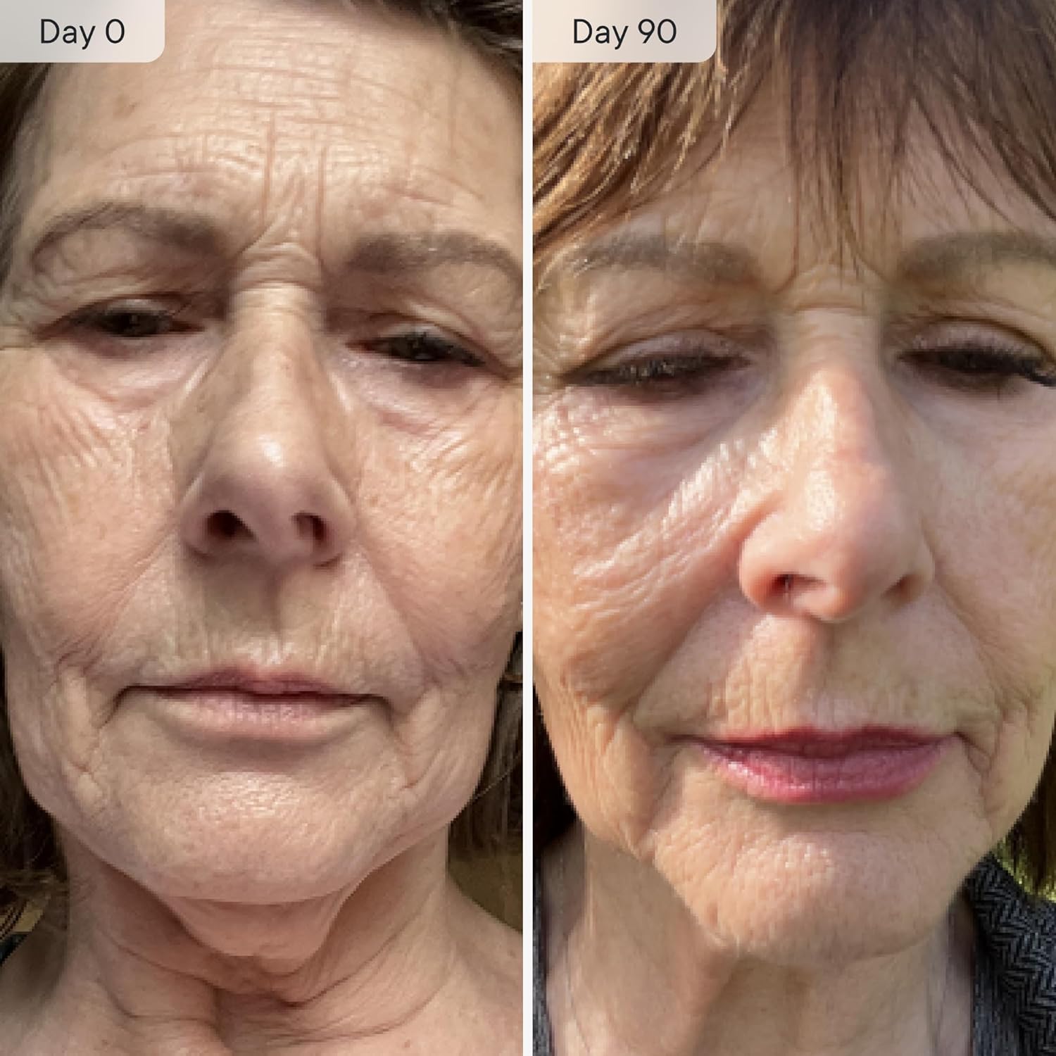 Qure - Microinfusion