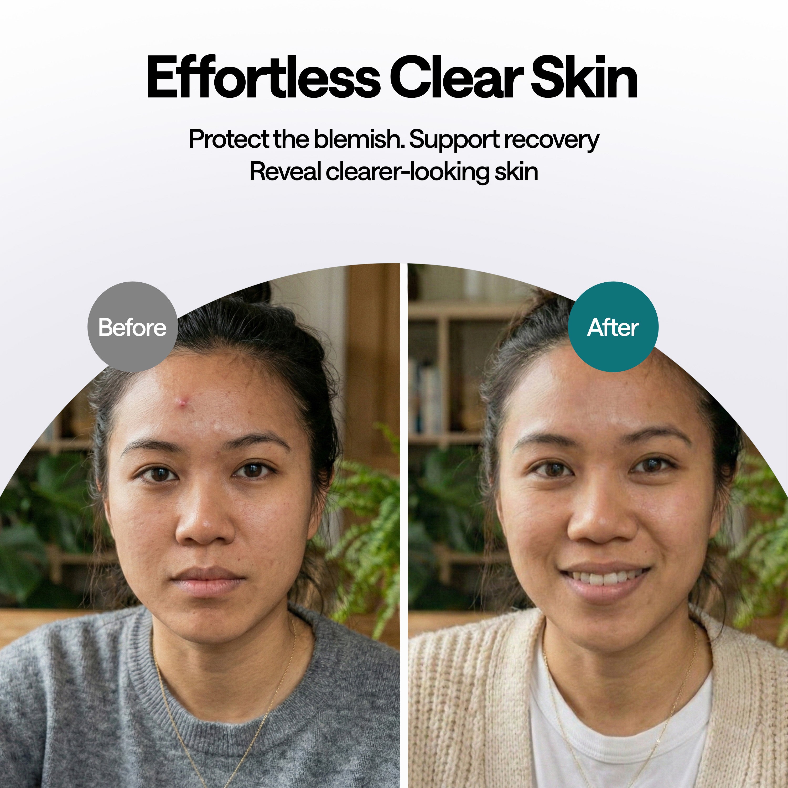 ELLE Magnesium Soft Acne Patch | Spot Treatment | Magnesium - The Magic Mineral |Hydrocolloid |Madecassic Acid | Tee Tree Oil Pimple Patches | Post-Breakout Acne Care | 11mm & 10mm Sizes | 45 Patches