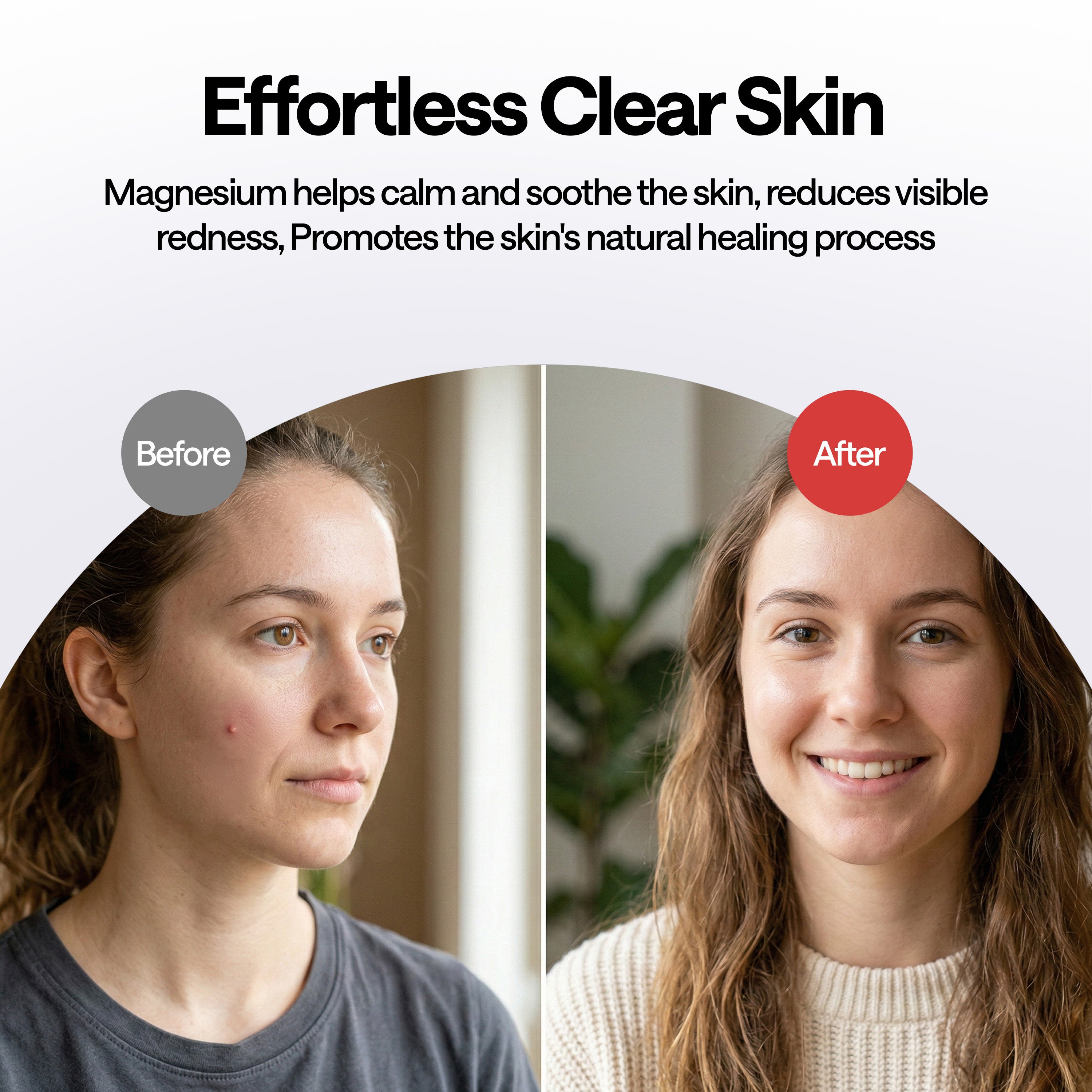 ELLE Magnesium Acne Patch | Micro-Dart | Magnesium - The Magic Mineral | Deep Penetrating Hydrocolloid Pimple Patch | Early Stage & Pus Pimples | Tea Tree & Madecassic Acid | 10 Patches